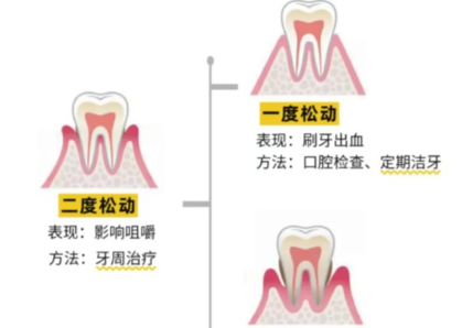 老年人牙齒松動了要怎么辦？